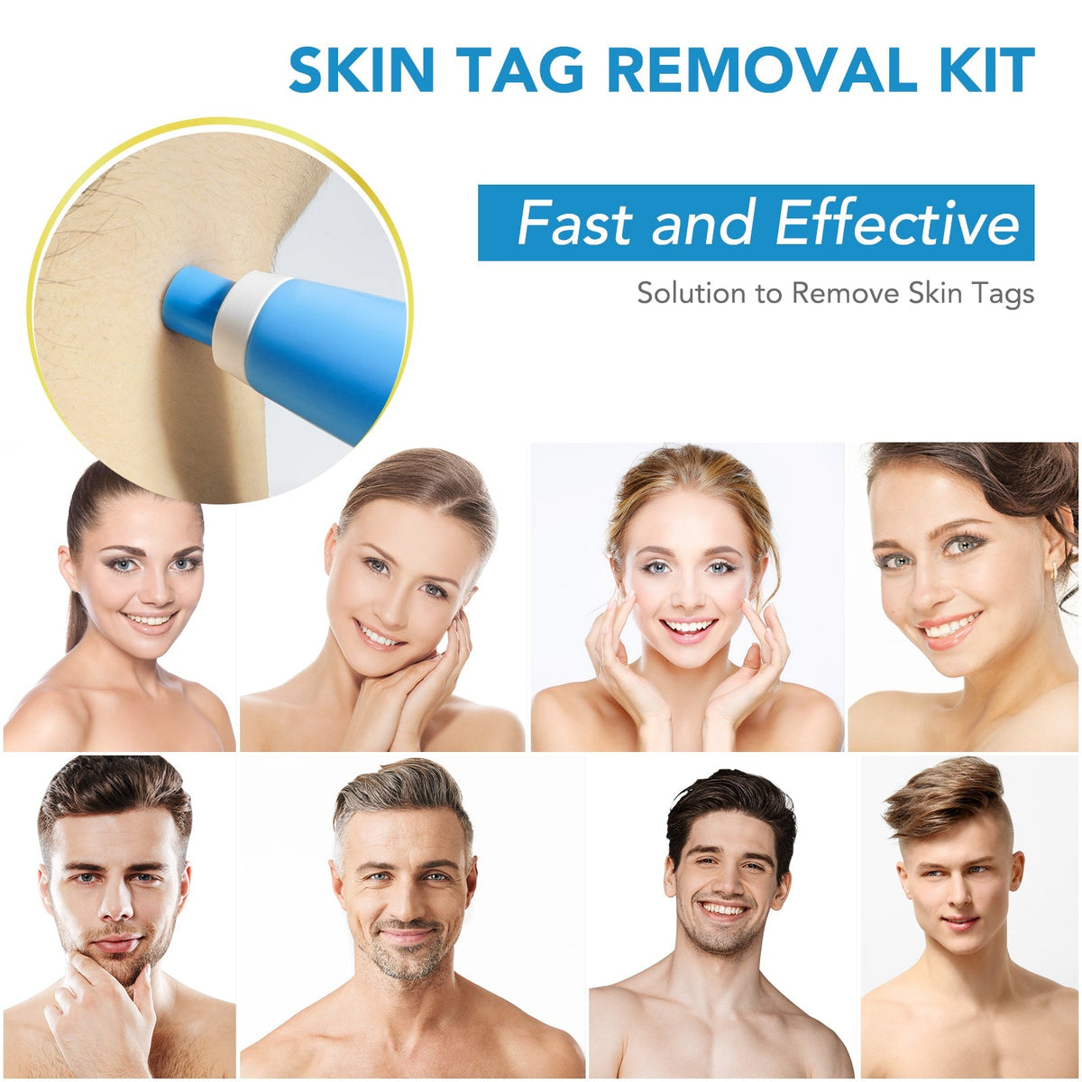 MicroCare Skin Solution - Advanced Skin Tag, Wart, Acne, and Pimple Removal Kit